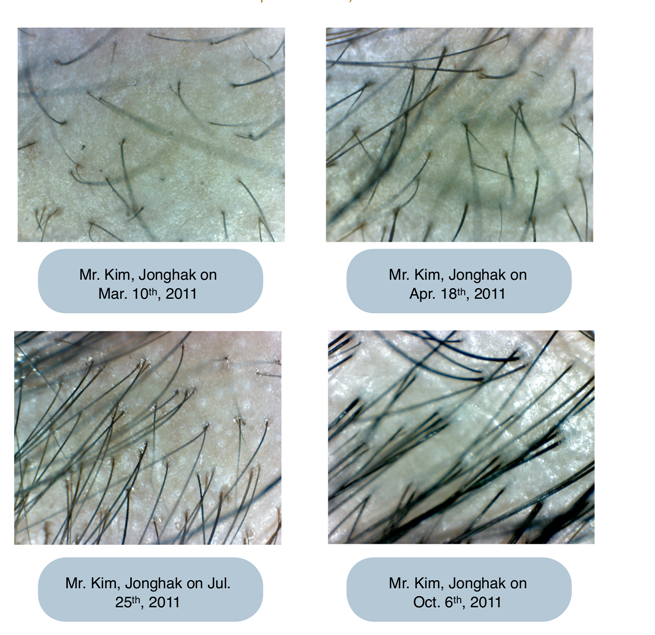 photo hair loss result_zpsokqdorpi.png