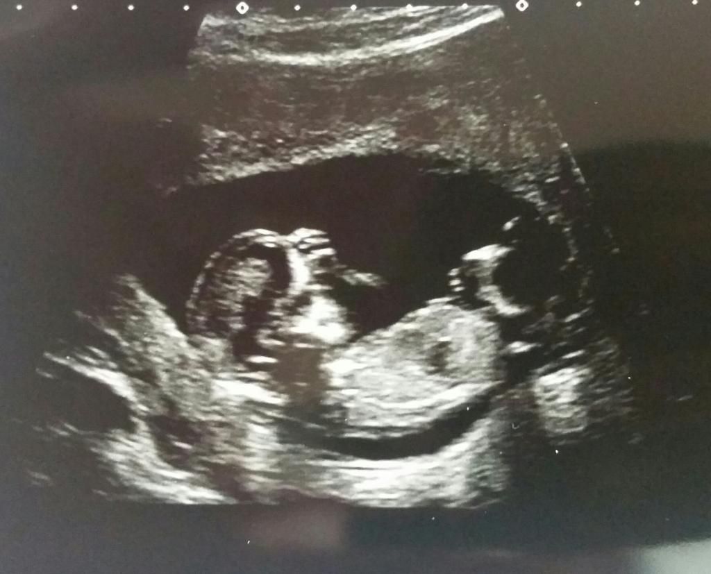 When will i have my dating scan uk